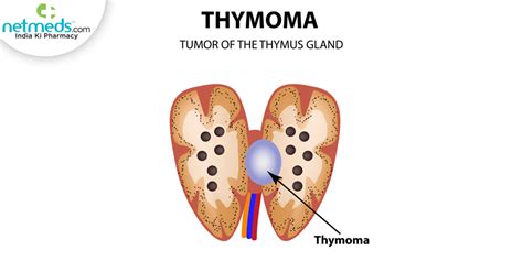 Thymoma: Causes, Symptoms And Treatment