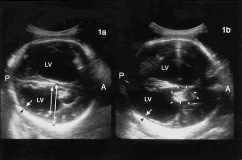 Figure 3 from Fetal Hydrocephalus Secondary to Intraventricular ...