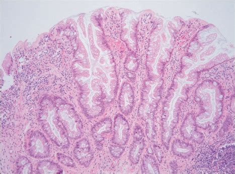 Photomicrographs of a colon polyp. A hyperplastic polyp exhibiting ...