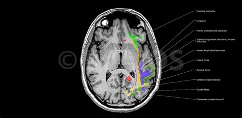 Brain: Atlas of human anatomy with MRI - eAnatomy