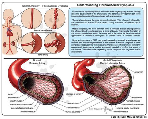 Fibromuscular dysplasia patient education