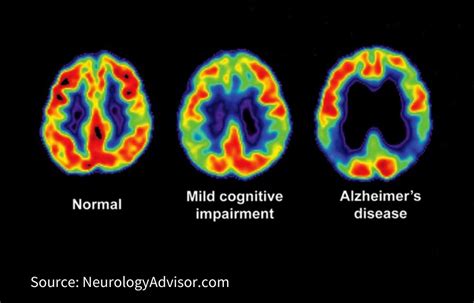 Mild Cognitive Impairment - Alzheimer's San Diego