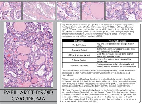 Papillary Thyroid Carcinoma | Iowa Head and Neck Protocols