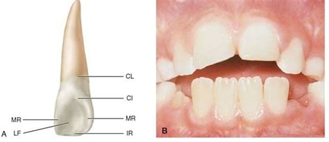 A, Maxillary right lateral incisor (lingual aspect). CL, Cervical line;CI, cingulum (also called ...