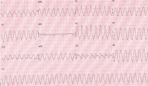 Twelve lead ECG during VT (Monomorphic VT, at a rate of 180/mt, RBBB... | Download Scientific ...