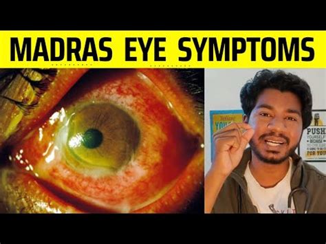 MADRAS EYE Symptoms | Treatment | Conjunctivitis | Tamil | Dr Ranjan ...