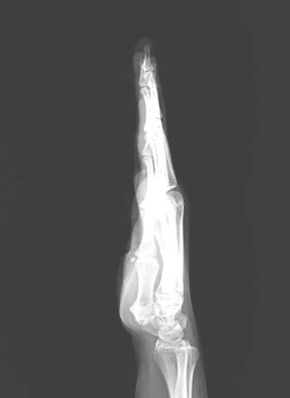 Lateral view of hand | Radiology Case | Radiopaedia.org