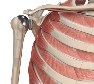 Shoulder Replacement Houston, Bellaire | Shoulder Surgeon Houston, Woodlands