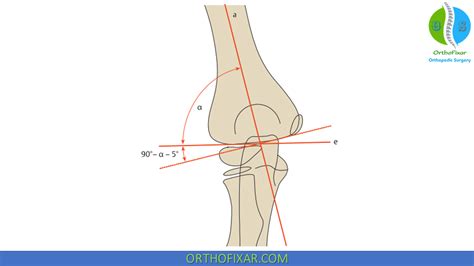 Baumann Angle For Elbow Joint Alignment | OrthoFixar 2024