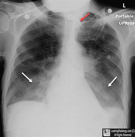 How Quickly Does Aspiration Pneumonia Develop