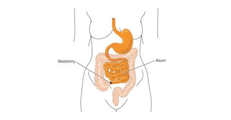 Ileostomy - Reversing a temporary ileostomy