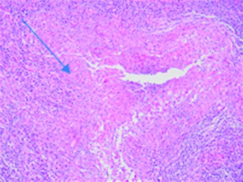 The arrow shows lymph node specimen granuloma with central necrosis ...