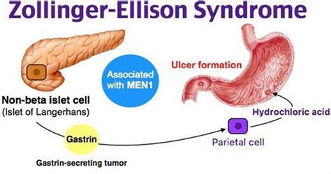 Gastrinoma causes, symptoms, diagnosis, treatment & prognosis