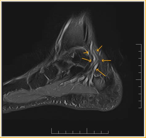 Tarsal Tunnel Varicosities: MRI - Sumer's Radiology Blog