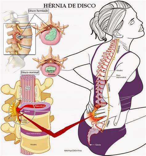 ¿Qué es una hernia discal? - Clínica Martín Gómez