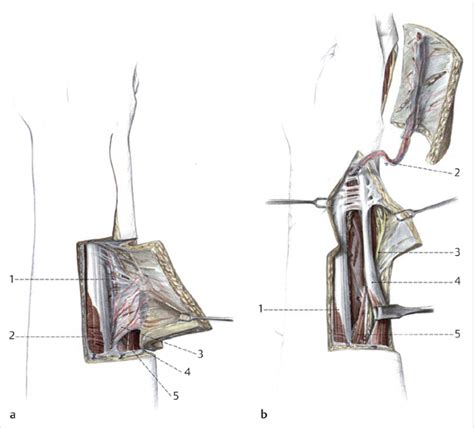 78 Radial Forearm Flap | Plastic Surgery Key