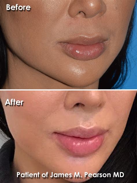 Lip Lift Photos - Before & After - Dr. James Pearson Facial Plastic Surgery