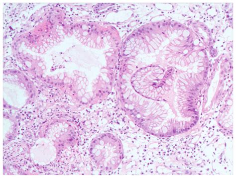 Biopsy specimen from gastric antrum mucosa displayed mucosal chronic ...