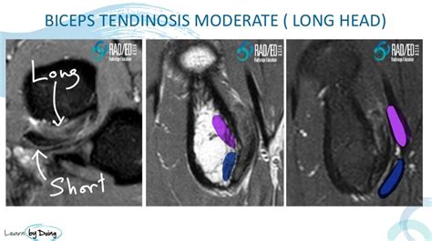 DISTAL BICEPS TENDON: DOUBLE TROUBLE - Radedasia