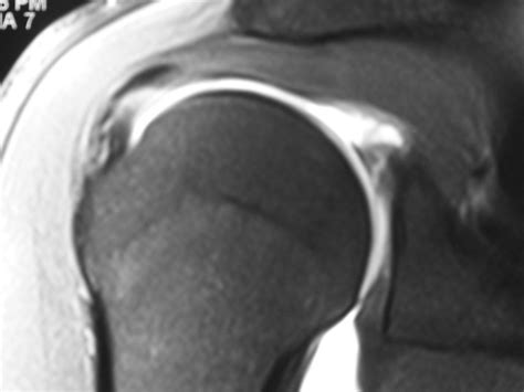 MRI of SLAP type 2 tear - Arizona Institute for Sports, Knees and Shoulders