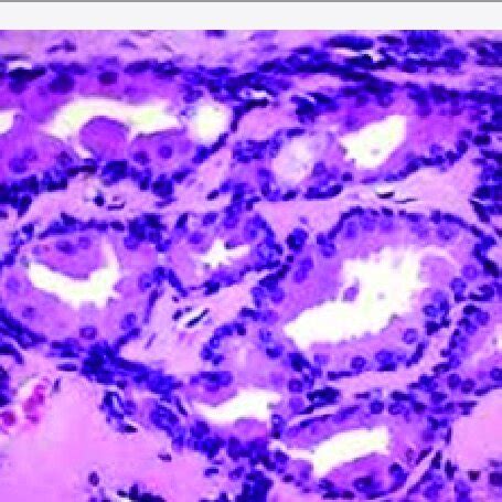 Ceruminous adenoma delineating glandular structures lined by dual... | Download Scientific Diagram