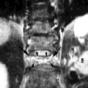 Coronal T2-weighted MRI of the lumbar spine of the same patient. An... | Download Scientific Diagram