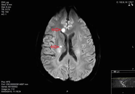 A: [MRI-DWI]: Well-defined right corpus callosum and right centrum ...