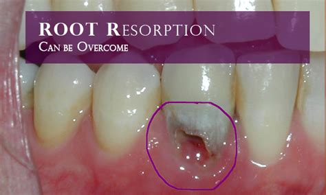 How Root Resorption Can Be Overcome ~ Dental Blog: Latest Dental News and Tips and Tricks ...