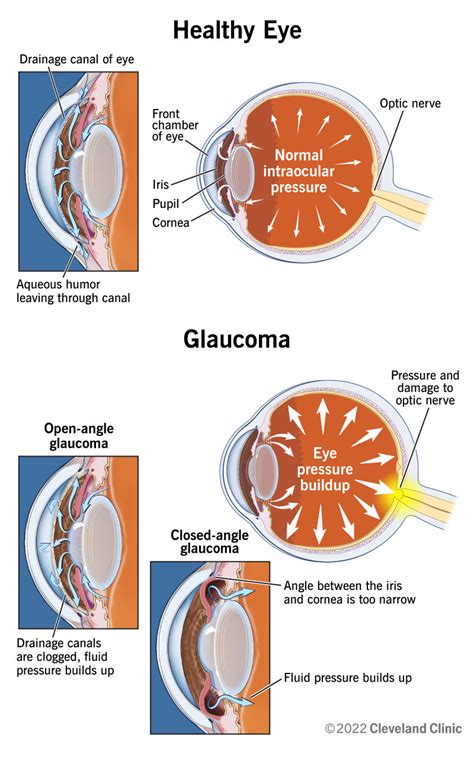 Glaucoma Eye Diagram