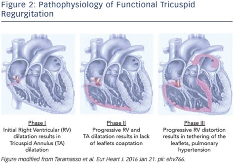 Management of Tricuspid Regurgitation: The Role of Transcatheter Therapies | ICR Journal