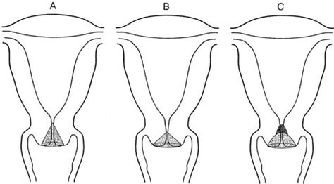 Treatment of Cervical Intraepithelial Neoplasia | GLOWM