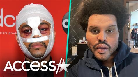 Weeknd Finally Explains His Face's Recent Journey