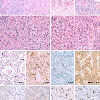 Histology and immunophenotype of oncocytic ependymoma. (A) Biphasic... | Download Scientific Diagram