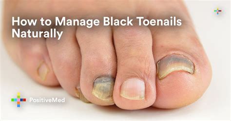 Black toenails, also known as runner’s toes, are rather common. They are called runner’s toes ...