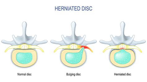 Herniated Disc: Symptoms & Causes| Och Spine at NewYork-Presbyterian