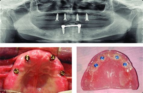 Group 2; Maxillary implant overdentures; A) postoperative panorama, b)... | Download Scientific ...