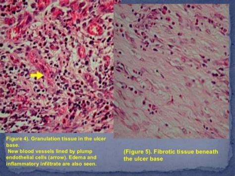 Granulation tissue formation