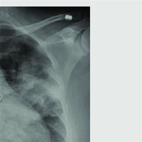 Chest X-ray showing bilateral perihilar pulmonary infiltrates reaching... | Download Scientific ...