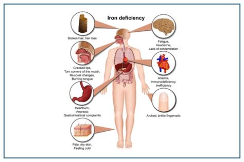 Anemia: Symptoms, causes, Complications, Treatment