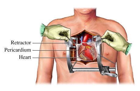 Open Heart Surgery Diagram - For Patients & Caregivers