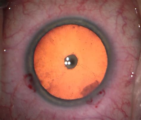 Posterior Polar Cataracts | Treatment For Posterior Polar Cataracts