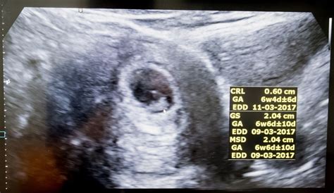 Is a 'fetal heartbeat' really a heartbeat at 6 weeks? » TrueViralNews