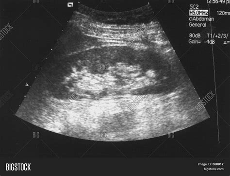 Kidney (ultrasound Image) Stock Photo & Stock Images | Bigstock