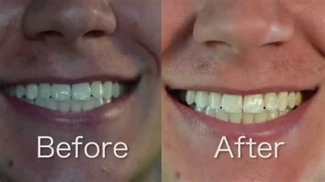 3d White Teeth Whitening Strips Review - TeethWalls