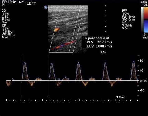 Leg Arterial normal – ULTRASOUNDPAEDIA