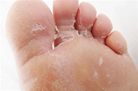 What causes skin peeling on bottom of feet? Real Facts