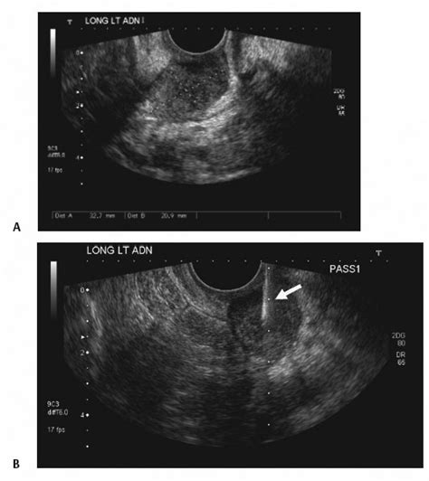 Endovaginal Procedures | Radiology Key