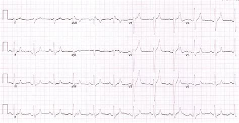 ECG showing tall and tented T waves. | Download Scientific Diagram