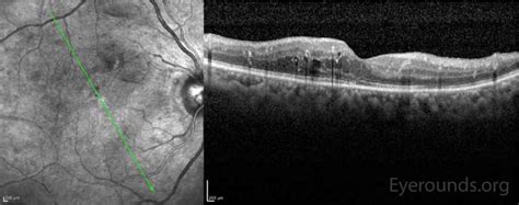 Diabetic Macular Edema