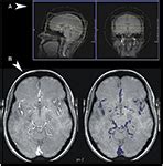 Frontiers | A Digital Atlas of Middle to Large Brain Vessels and Their Relation to Cortical and ...